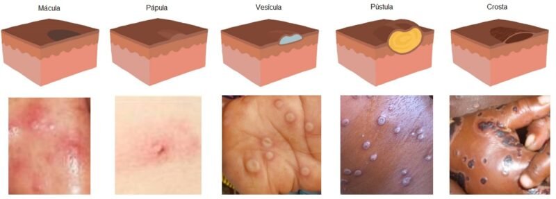 lesões de mpox , evolução